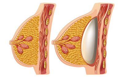 L’AUGMENTATION MAMMAIRE ET LES IMPLANTS DE NOUVELLE GÉNÉRATION