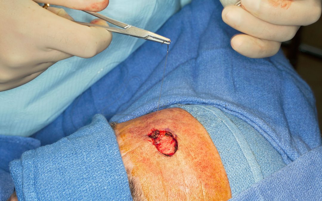 Chirurgie des tumeurs cutanées