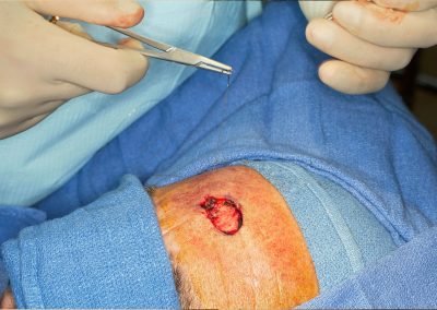 Chirurgie des tumeurs cutanées