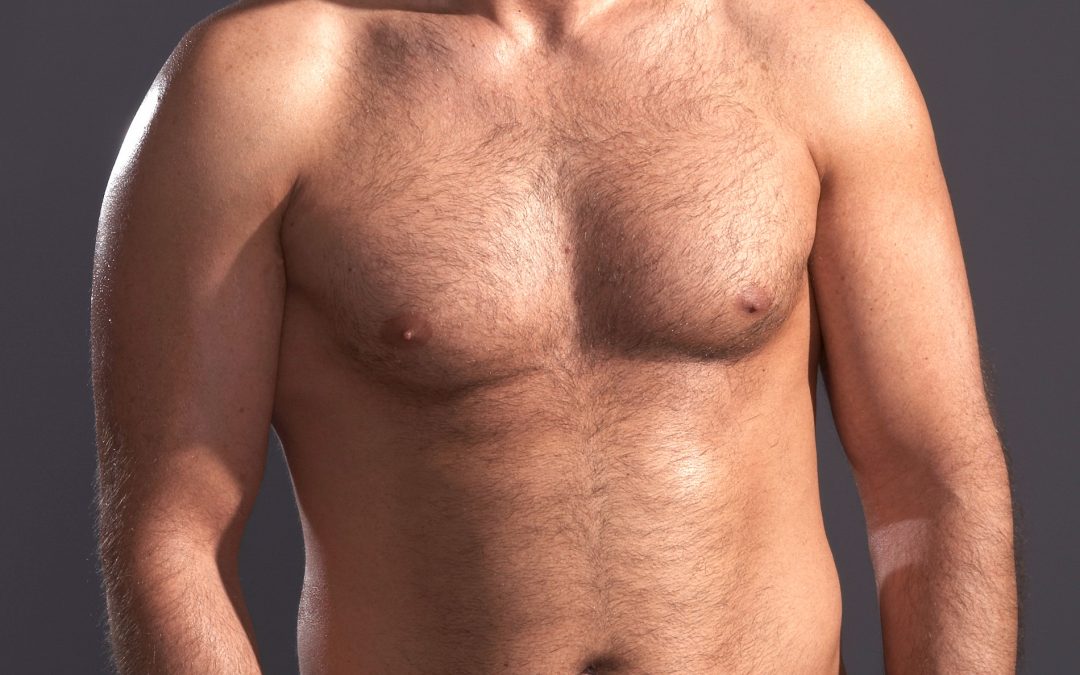 Gynecomastie