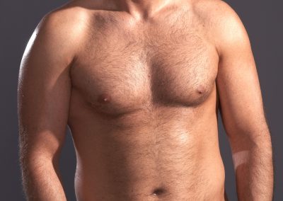 Gynecomastie